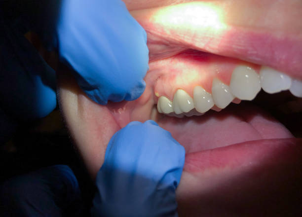 Best Emergency Care for Gum Disease in Splendora, TX